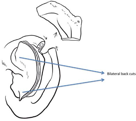 Blunt Dissection Of Cartilage From The Posterior Skin And Advancement
