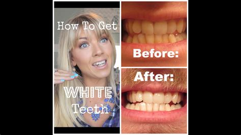 To use this remedy, simply follow these steps it is the best way to make your teeth whiter. How To Get WHITE Teeth at Home *Demo* & Actual Pictures ...