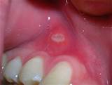 Photos of Sore On My Gums Treatment