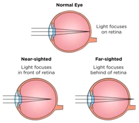 Myopia Hyperopia Presbyopia And Astigmatism Image Source 22