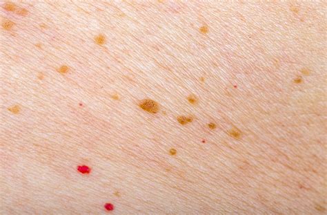 Cherry Angiomas Mclean Va And Woodbridge Va Skin And Laser Dermatology