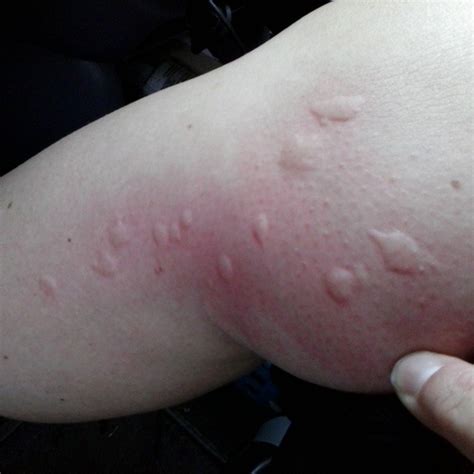 List Pictures Sand Flea Bites On Humans Pictures Updated