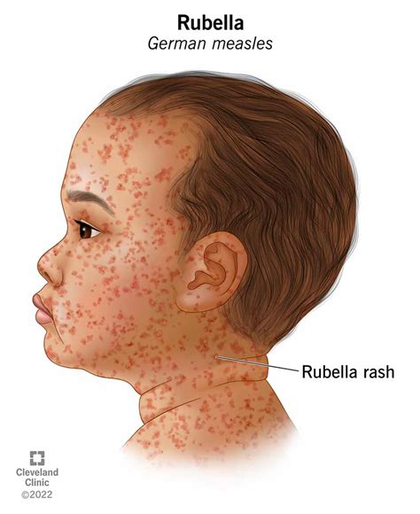 Rubella German Measles Symptoms Treatment And Prevention