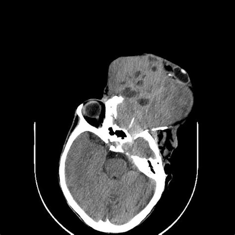 Orbital Rhabdomyosarcoma Radiology Case Radiology