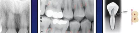 Radiology Ch 33 Interpretation Of Dental Caries Flashcards Quizlet