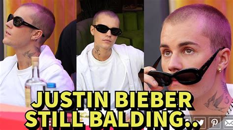 Justin Bieber Is Still Losing Hair In 2022 Proof Youtube