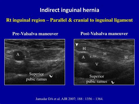 Ultrasound Of The Abdominal Wall Hernias