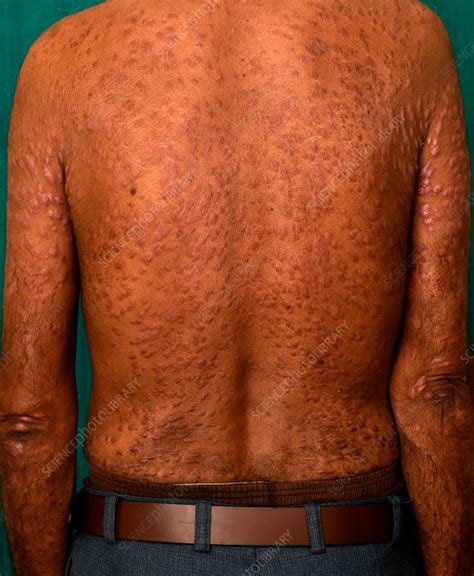 Diffuse Cutaneous Leishmaniasis Stock Image C Science Photo Library