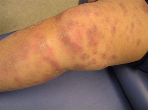 Erythema Nodosum Pictures Causes Symptoms Diagnoses Treatment Healthmd