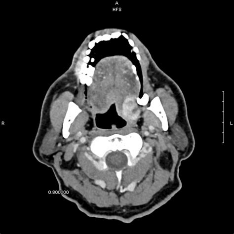 Cureus Renal Cell Carcinoma In The Head And Neck Case Presentation