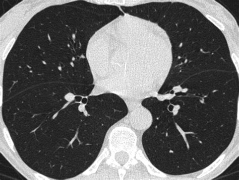 Thin Section Ct Of The Lungs The Hinterland Of Normal Radiology My