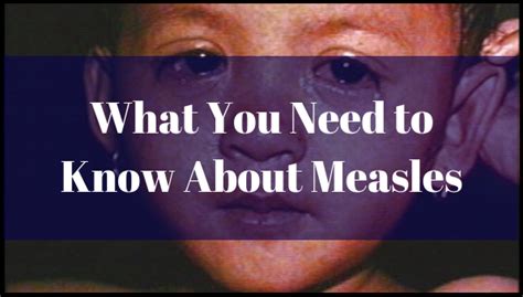 What You Need To Know About Measles Visionamerica Doctors