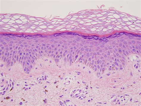 Lichen Amyloidosis Dermatopathology