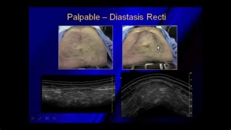 Ultrasound Of Hernias Diastasis Recti Ultrasound Med Quick