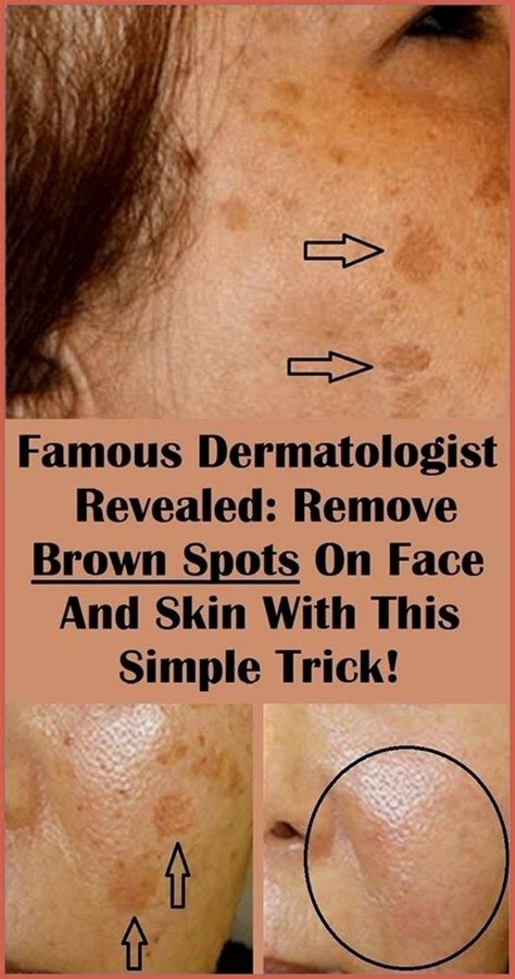 Famous Dermatologist Revealed Remove Brown Spots On Face And Skin With