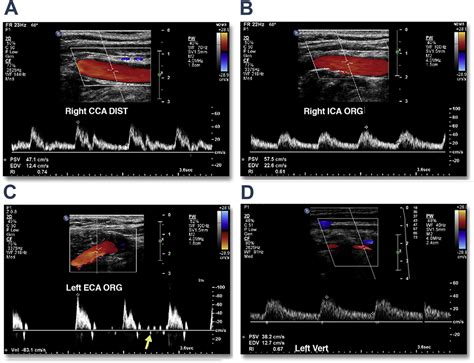 Manifestations Of Cardiac Disease In Carotid Duplex Ultrasound