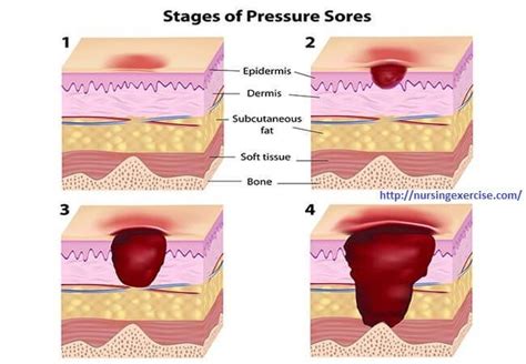 Bedsore Stages Pressure Ulcer Skin Ulcer Nursing Care