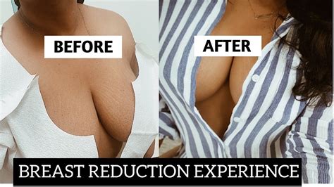 My Breast Reduction Experience How Much It Really Costmy Real Bra Size And Did I Regret It