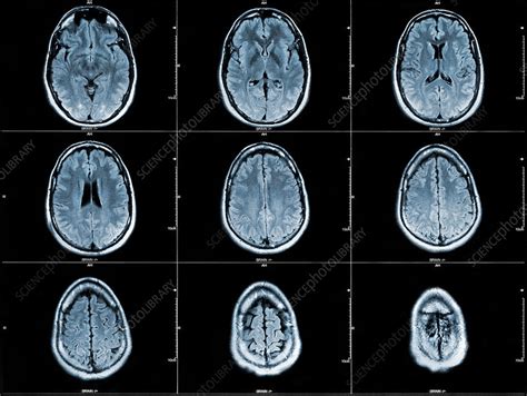 Axial Brain Mri Stock Image C0047422 Science Photo Library