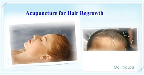 Acupuncture Massage Clinic Scarborough Acupuncture For Hair Loss
