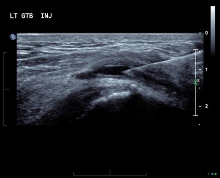 Trochanteric Bursitis Radiology Reference Article Radiopaedia Org