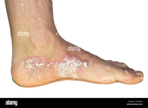 Allergic Reaction Hi Res Stock Photography And Images Alamy