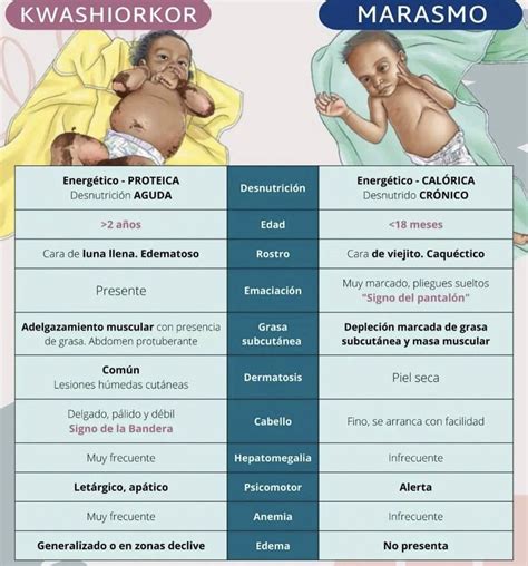 Kwashiorkor Y Marasmo Pediatría Enfermería Farmacología Estudiante