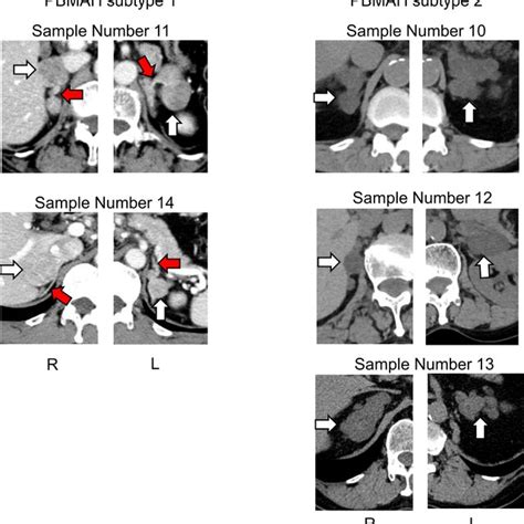 Images Of Adrenal Glands Of Patients With Pbmah White Arrows Indicate