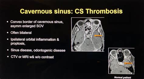 Cavernous Sinus Thrombosis Mrv