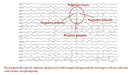 Generalised Periodic Epileptiform Discharges
