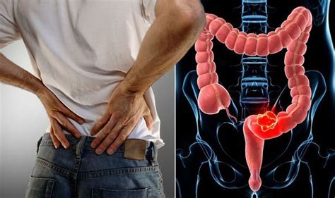 Bowel Cancer Warning The Pain In Your Back Passage You Should Never