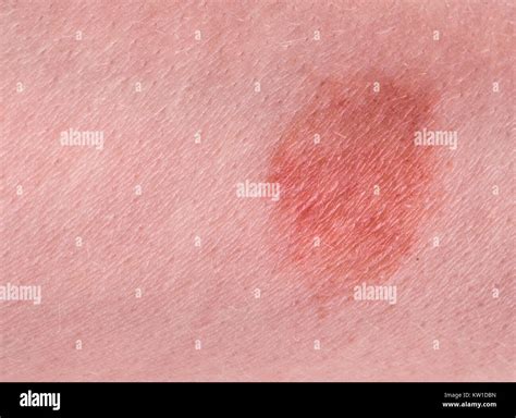 The Great Red Spot On The Skin Closeup Stock Photo Alamy