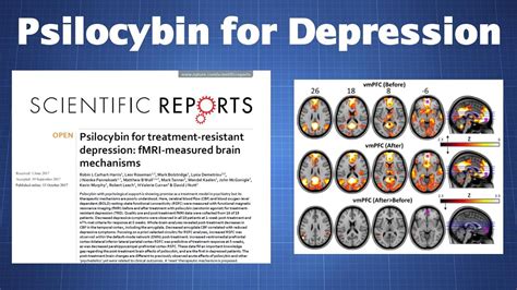 How Psilocybin Treatment Alters Brain Activity In Depressed Patients