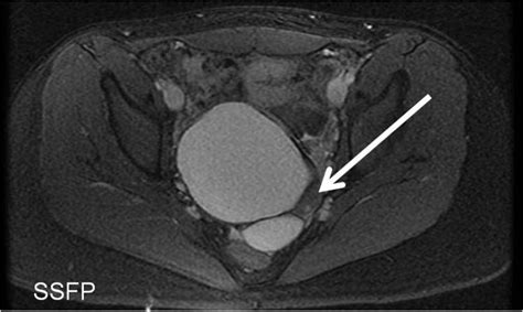 Ovarian Dermoid Cyst Mri Radiologypics