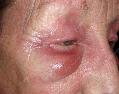 Skin Rash In Dermatomyositis Stock Image C0269079 Science Photo