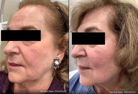 Genius Rf Microneedling Before And After Photos Patient 42 Washington Dc Mi Skin Dermatology