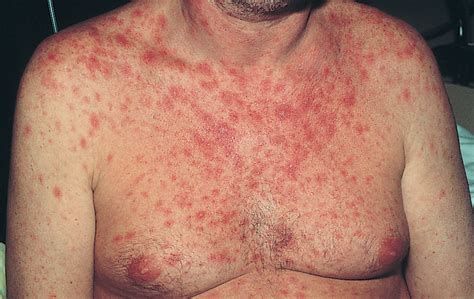 A Maculopapular Rash In A Patient With Severe Diarrhea Dermatology