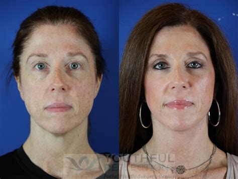 Co2 Laser Skin Resurfacing Before And After Photos Patient 49 Nashville