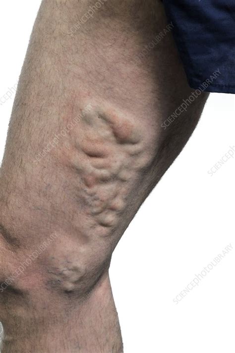 Varicose Veins On The Thigh Stock Image C010 3353 Science Photo Library