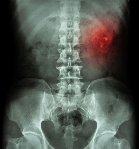 Kub X Ray Anatomy