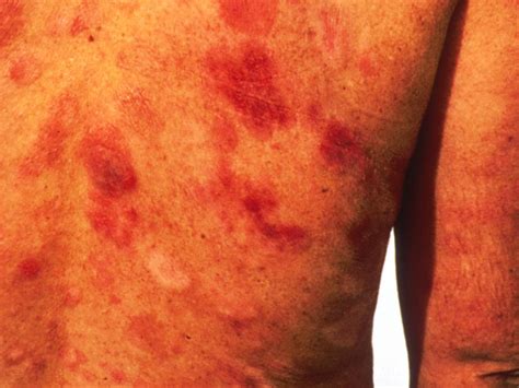 Kaposis Sarcoma Is A Symptom Of Which Sexually Transmitted Disease