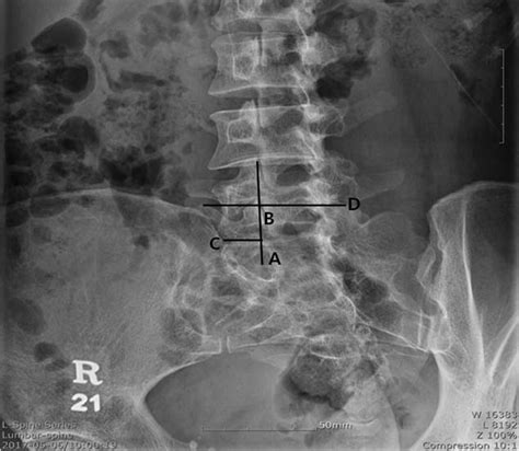 Lumbar Spine Posterior View