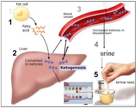 Possible causes, signs and symptoms, standard treatment options and means of care and support. Ketones in Urine Causes, Normal Values, Test Procedure