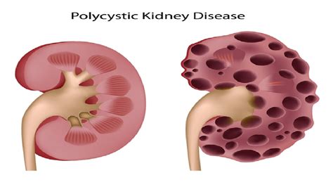 Polycystic Kidney Disease Symptoms Adult Polycystic Kidney Disease