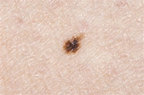 Mole Naevus On The Skin Stock Image C0041221 Science Photo Library