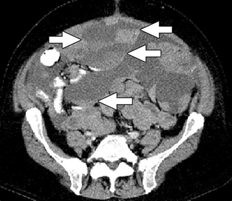 Peritoneal Sarcomatosis Versus Peritoneal Carcinomatosis Imaging