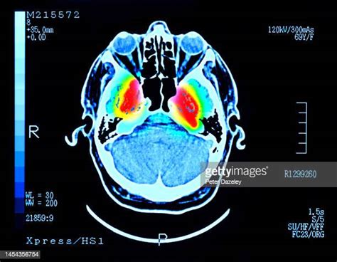 Parkinsons Disease Brain Photos And Premium High Res Pictures Getty