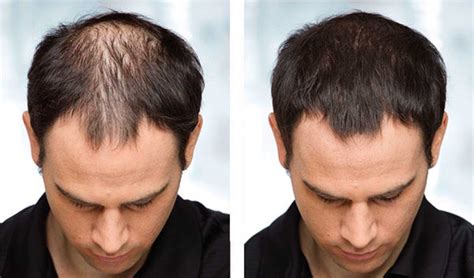 Effective Hair Loss Treatments For Men And Women