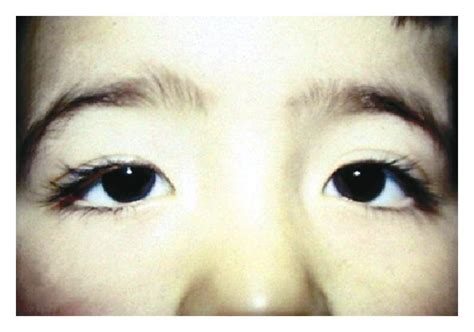 Figure 3 The Long Term Results Of Frontalis Suspension Using