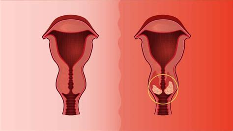 Este órgano se divide en dos partes: Câncer de colo do útero | Drauzio Varella - Drauzio Varella